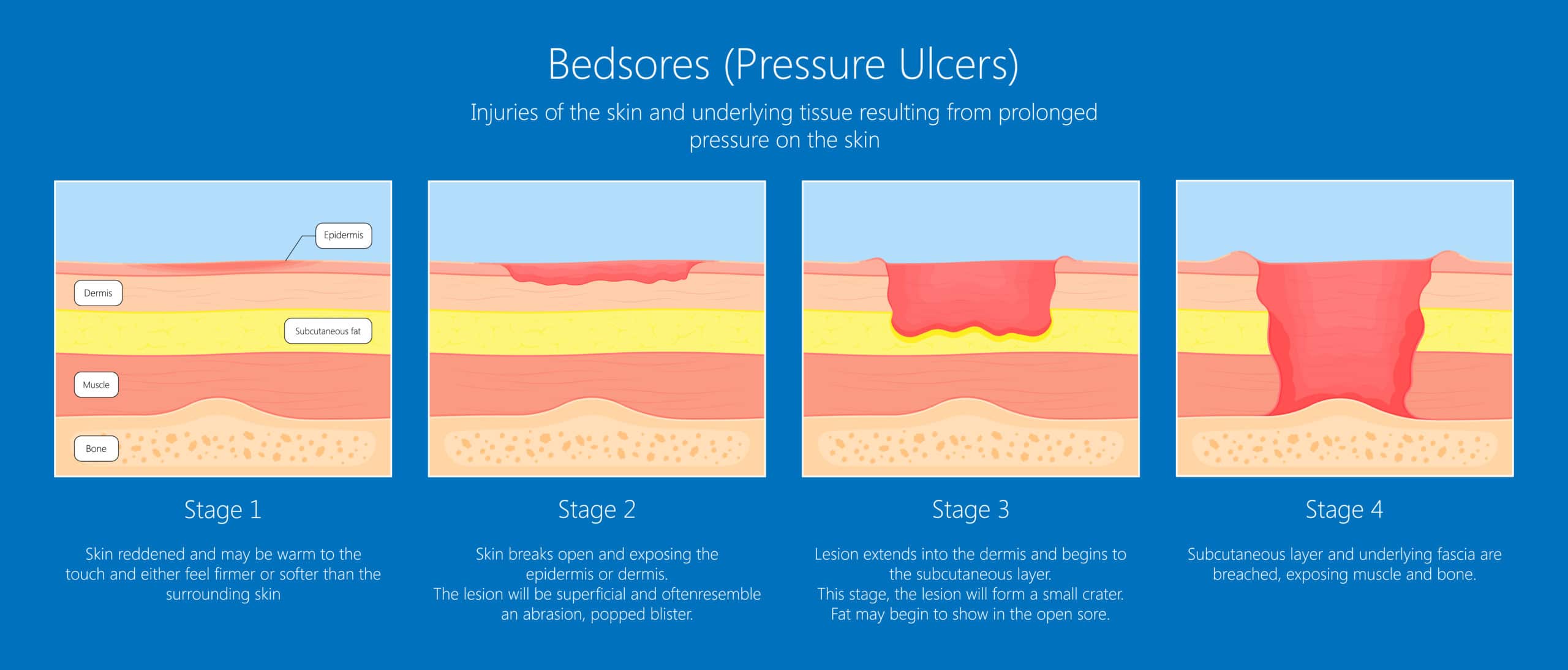 What Are The Different Stages Of Bedsores MedMalFirm
